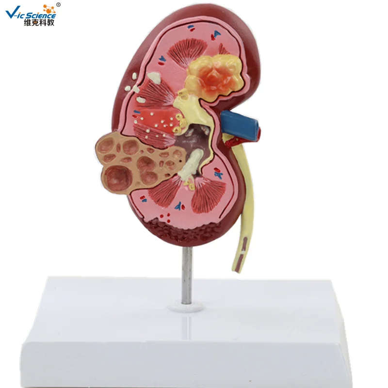 医学教学泌尿系统模型人体解剖学肾脏模型肾脏病变模型