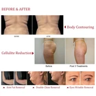 brilliant body sculpting fat loss body shape equipment vacuum velashape slimming machine