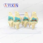 Human knee model 4 stage knee joint disease model four-stage disease knee model