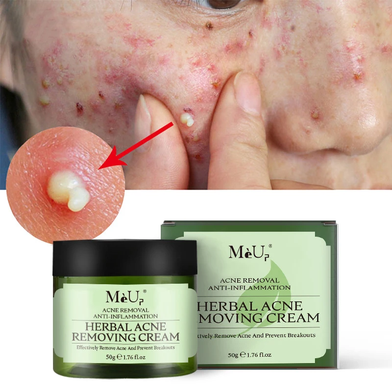 Manufacturers 100% Natural Face Treatment Skin Care Herbal Anti Acne Removal Facial Cream
Manufacturers 100% Natural Face Treatment Skin Care Herbal Anti Acne Removal Facial Cream