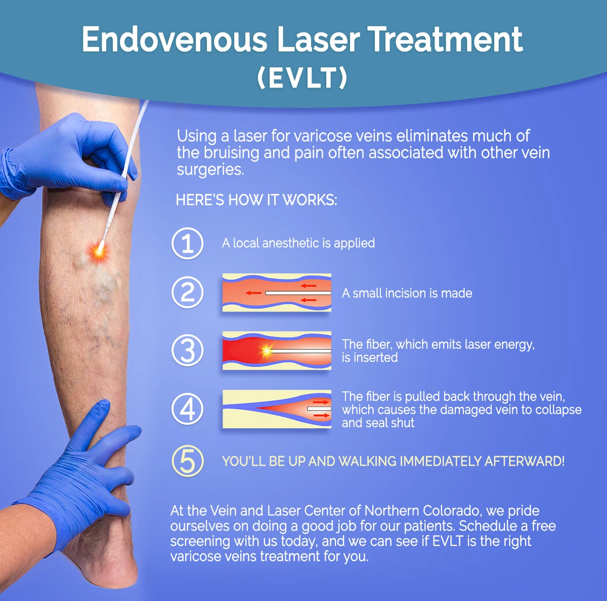 varicose vein laser surgery