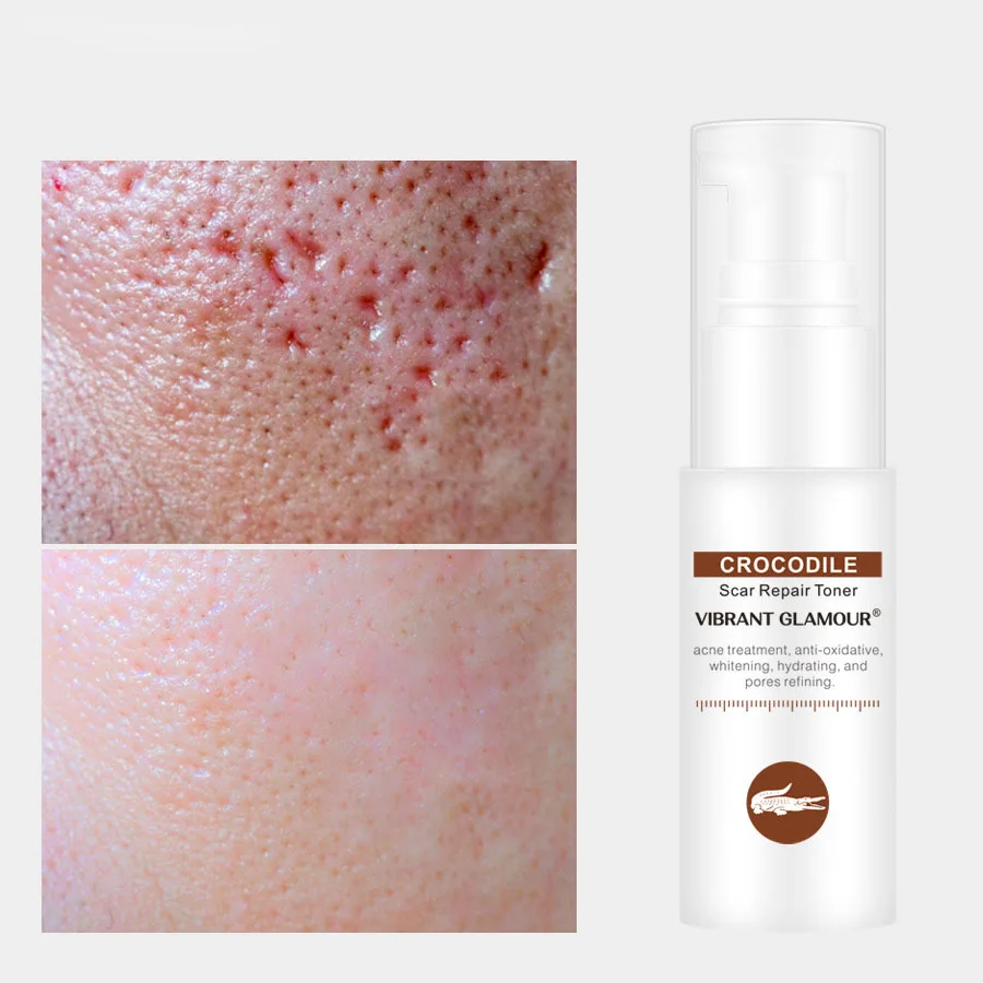 OEM Custom Label Crocodile Peptide Stretch Body Marks Acne Scars Removal Face Skin Care Toner for Skin Anti Wrinkles Moisturizer, Transparent
OEM Custom Label Crocodile Peptide Stretch Body Marks Acne Scars Removal Face Skin Care Toner for Skin Anti Wrinkles Moisturizer, Transparent