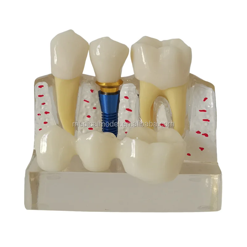 透明修复牙模型教育牙科种植牙牙研究牙模型