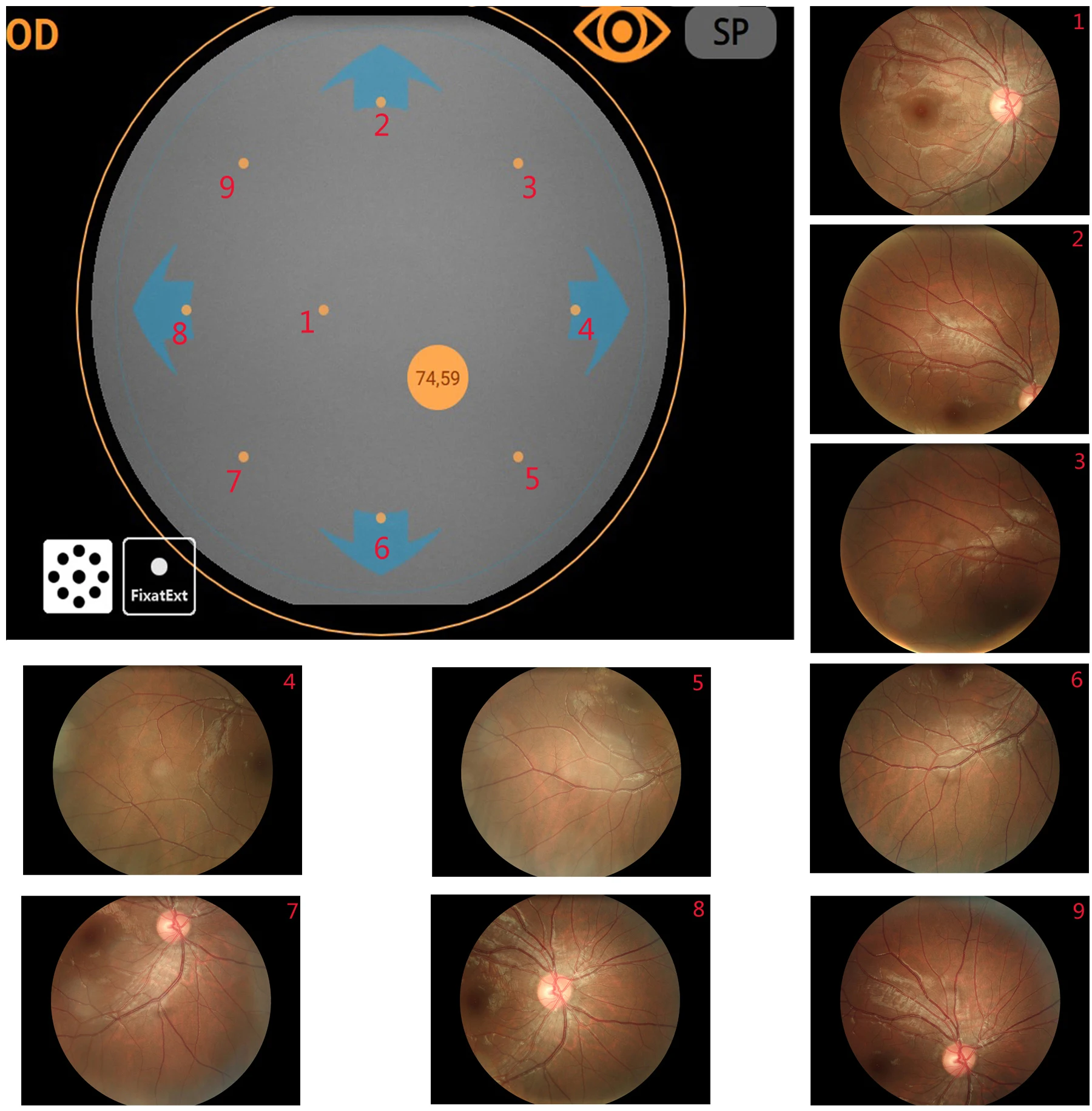 Non-mydriatic Automated Fundus Camera With Fluorescein Angiography