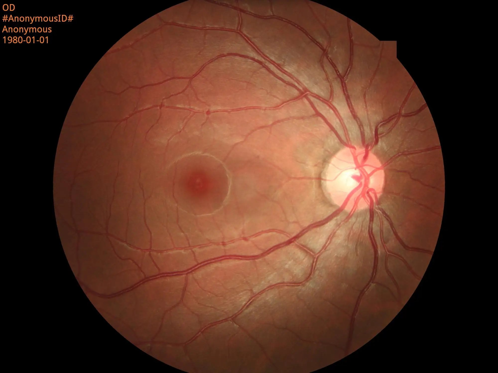 Non-mydriatic Automated Fundus Camera With Fluorescein Angiography