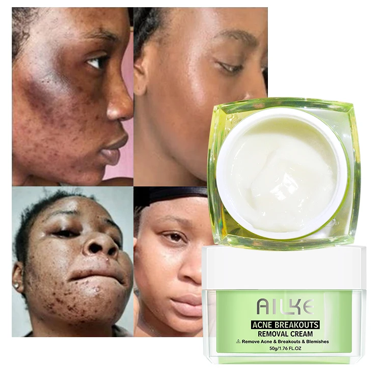 

ailke Advanced Multiple Plant Extract Anti Acne Blackhead Remover Cream Acne Treatment For Black Women