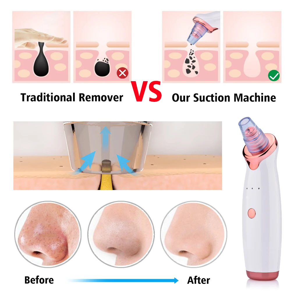 Hailicare Facial Dead Skin Acne Vacuum Cleaner Black Head Removal Pore Cleanser Facial Massage Mini Blackhead Remover .jpg