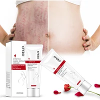 

Postpartum Stretch Mark Cream Removal Scar and Stretch Mark Removal Cream Stretch Mark Cream