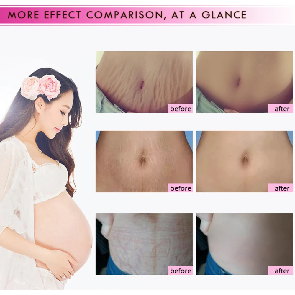 High Quality Scar Removal Cream