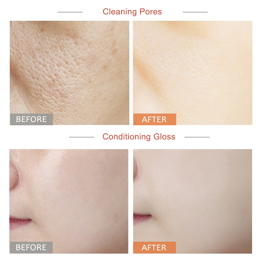 Aha Bha Serums Peeling Solution Peel Aha. Body Blackhead Power Liquid