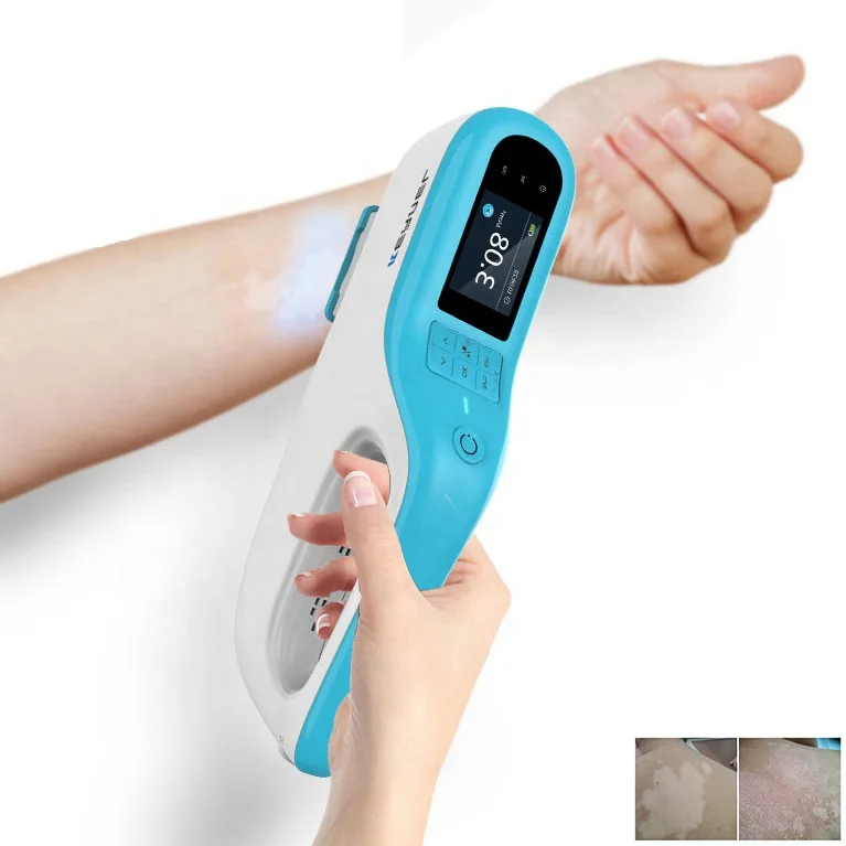 

Kernel KN-5000E Beauty equipment psoriasis lamp portable Excimer excimer laser 308nm psoriasis vitiligo laser for vitiligo