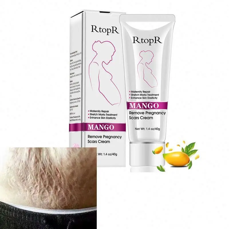 

Best Acne Scar Cream and Stretch Marks Removal Cream Treatment for Acne
