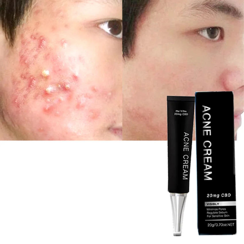 

Sylvapure Organic skin care Professional melasma remove acne pimples cream for acne treatment