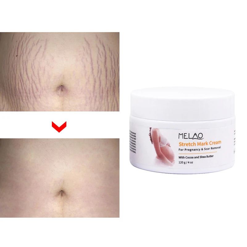 

Wholesale Hot Selling Ance Scar and Stretch Mark Removal Cream for Pregnancy Scars Treatment Body Skin Care