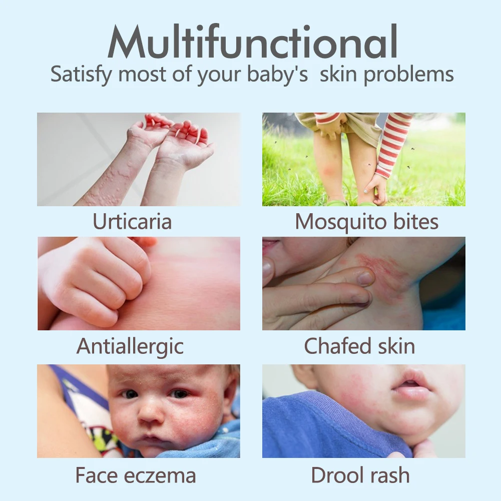 Baby Essential Oil Soothes Eczema Itching Diaper Rash And Moisturizes The Skin Continuously For 8 Hours Buy Baby Eczema Eczema Diaper Rash Product On Alibaba Com