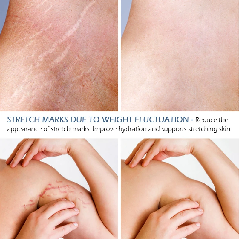 stretch marks removal-3.jpg