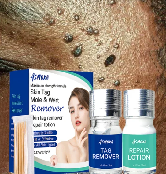 

2*5ml Removing Against Moles Remover Anti Verruca Remedy Liquid Pen Treatment Papillomas Skin Tag Warts Removal