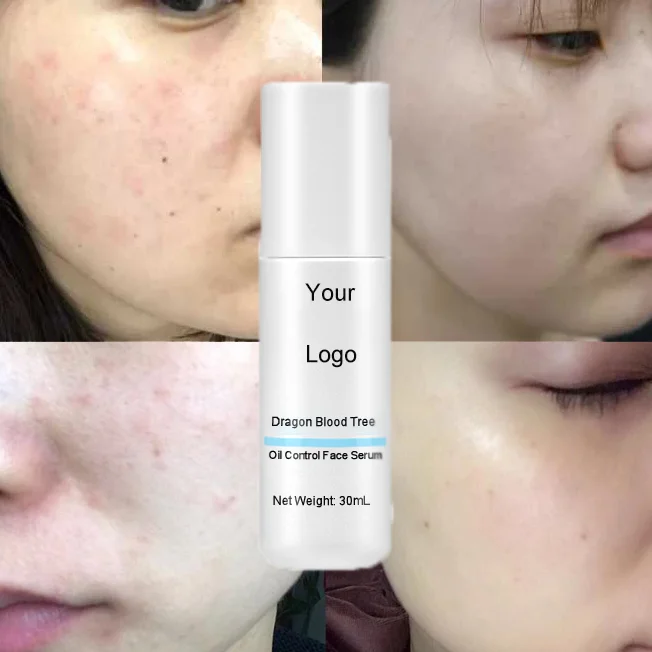 

OEM Natural Glowing Face Serum Shrink Pores Remove Dark Spots 12% AHA + 3% BHA Exfoliating Glow dracaena Acne Treatment Serum