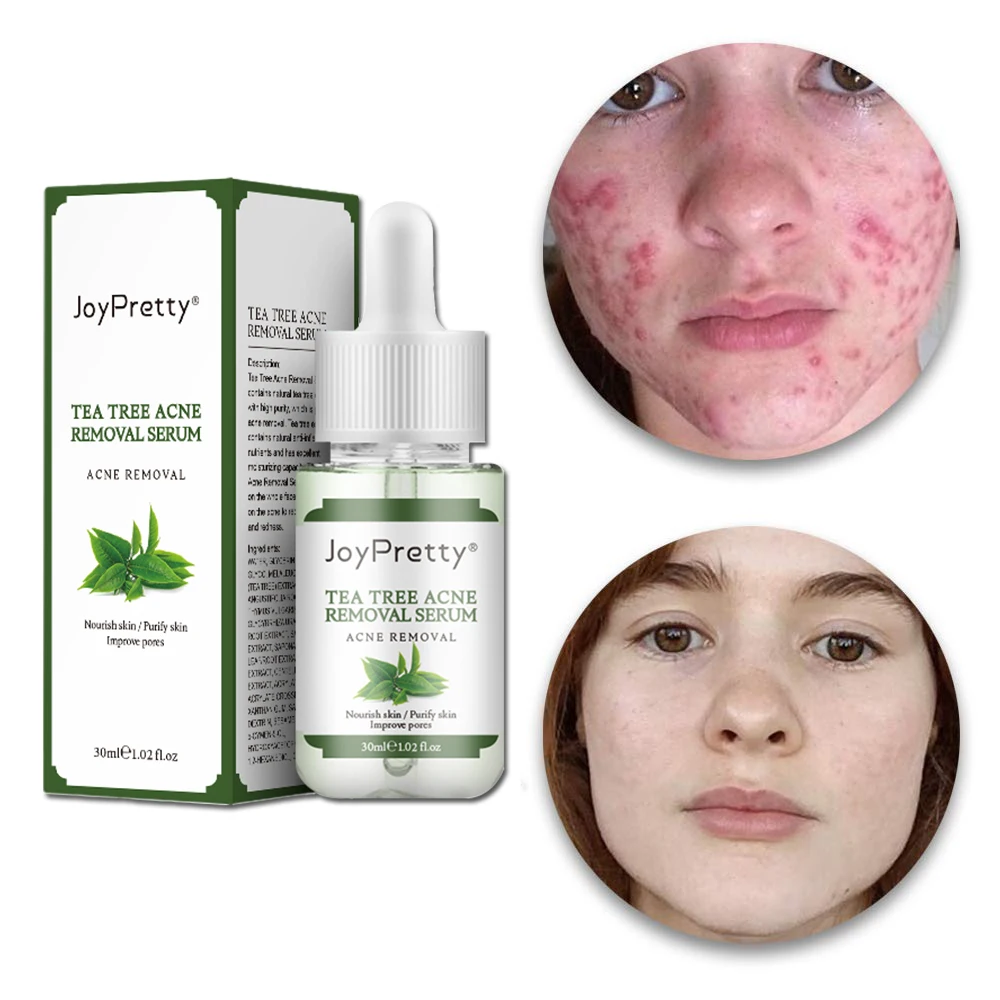 

Private Label Korean Natural Organic Tea Tree Herbal Skin Care Repair Treatment Acne Pimple Remover Anti Acne Face Night Serum