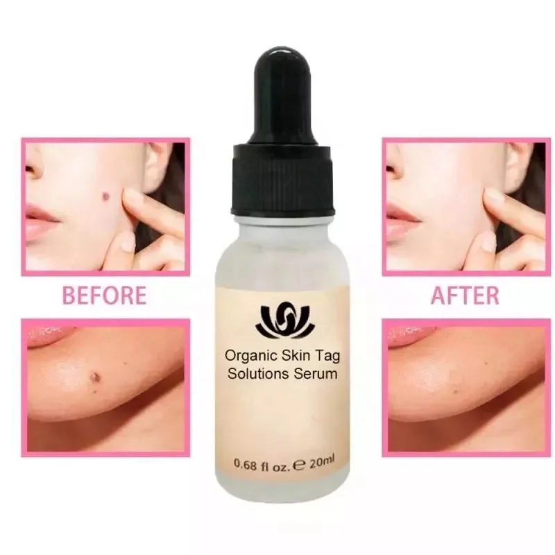 

2022 Wholesale New Organic Skin Tag Removal Solution Dark Spot Corrector Remover Painless Face Wart Mole Freckle Treatment Serum