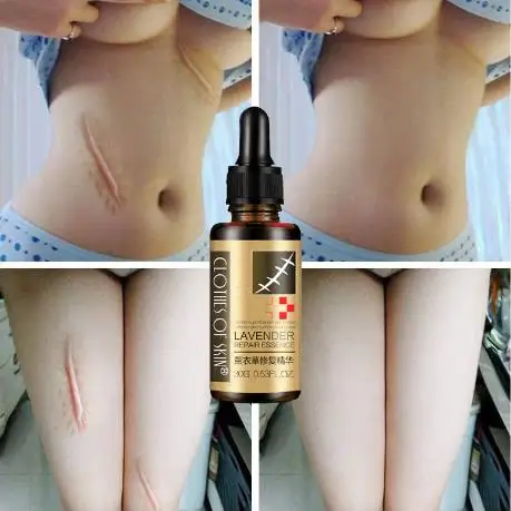 

Epsilon Skin Care 100% Pure Natural Organic Anti Acne Whitening Stretch Marks Scar Removal Lavender Essential Oil 10ml