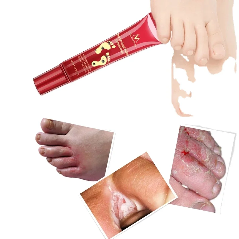 

Wholesale Feet Repair Cream Herb Anti-Fungal Beriberi Treatment Cream