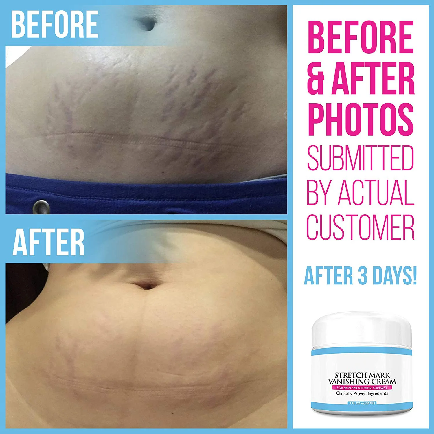 stretch marks cream 3.png