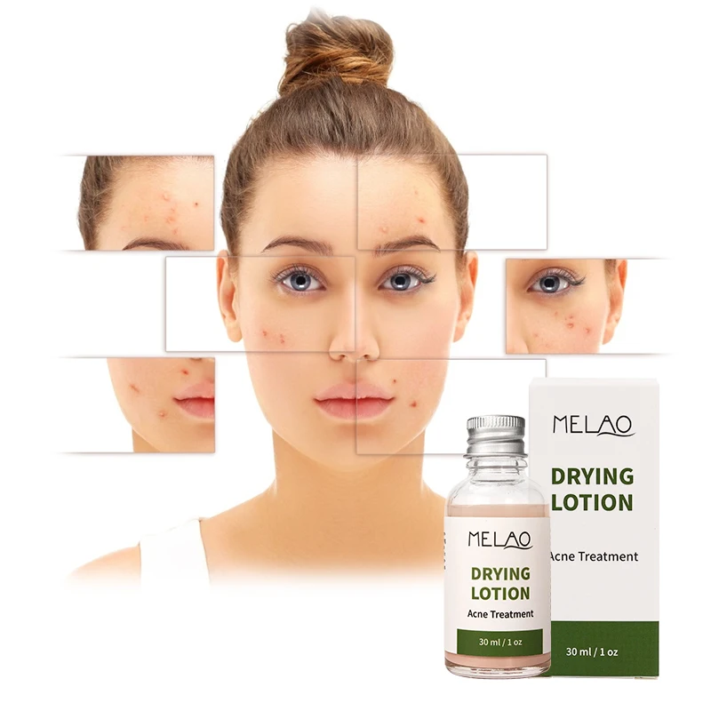

Acne Spot Treatment Face Skin Pimple Lotion Spot Treatment Dry Out Pimples Blemishes Clean pores Acne Drying Lotion, Transparent