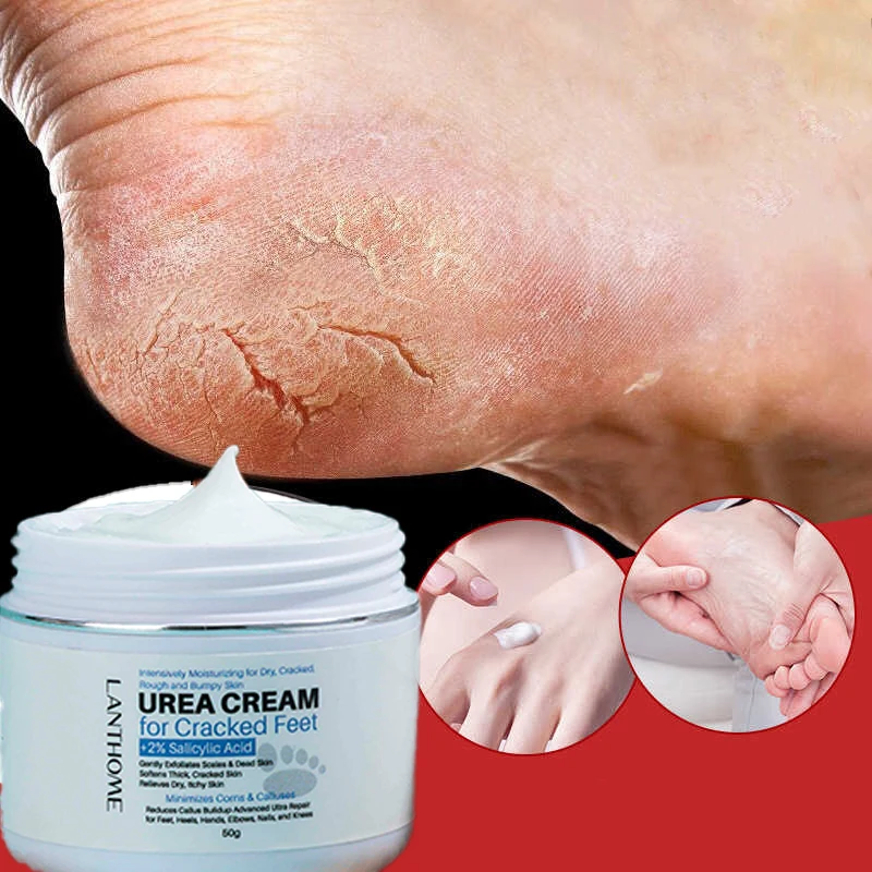 

Best Callus Remover Urea Foot Anti Crack Cream Remove Dead And Dry Skin Moisturizing Hand Foot Cream