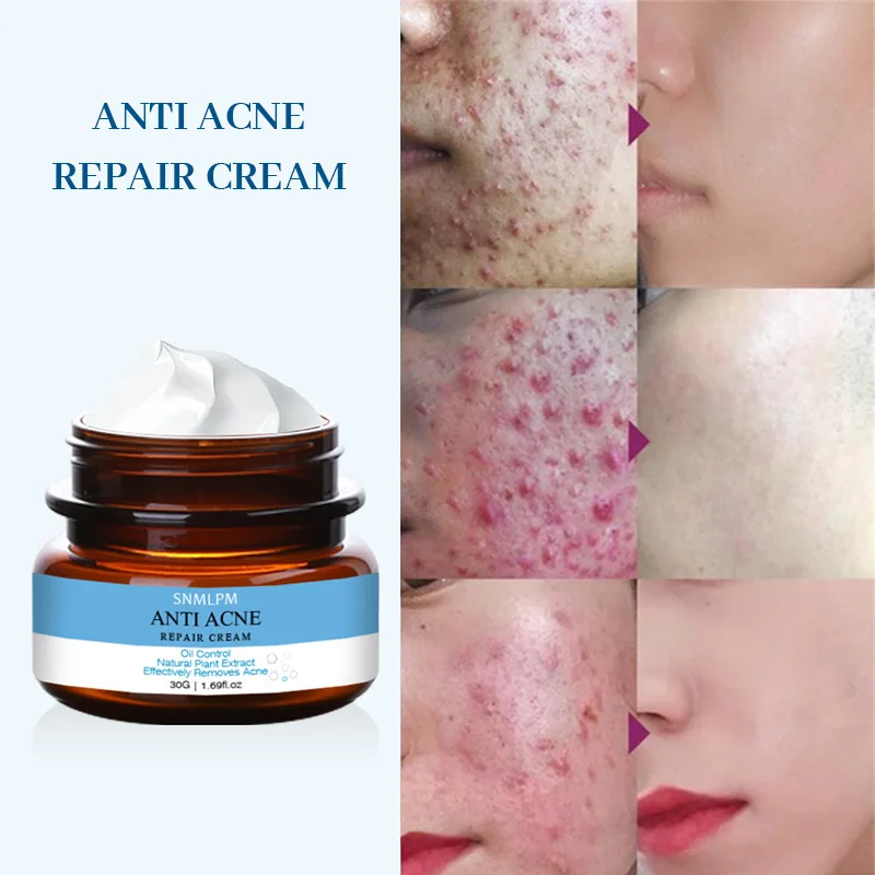 

Private Label Scars Removal Face Cream Beauty Pure Skin Care Whitening Facial Moisturizing Cream for Acne Treatment