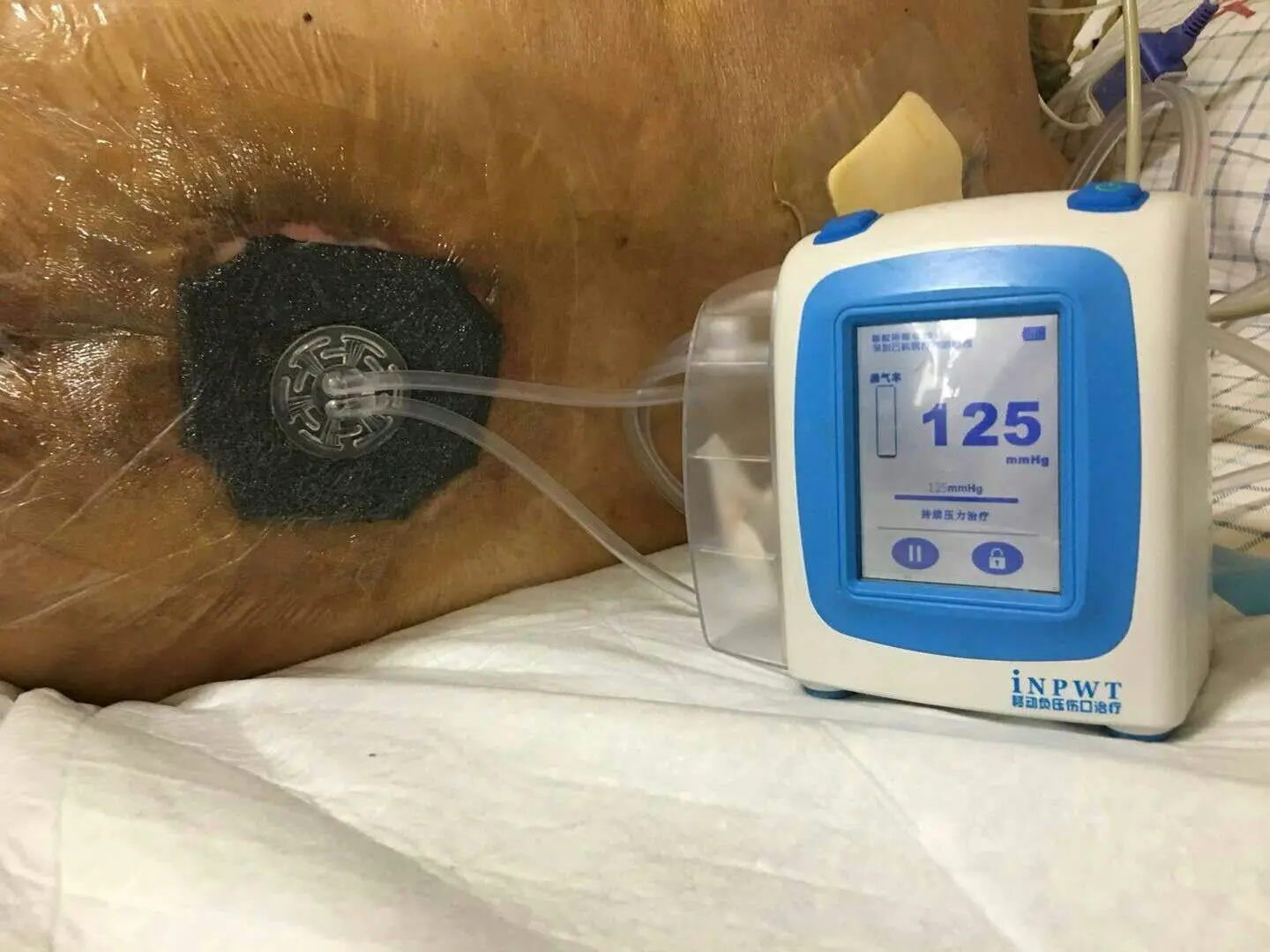 external npwt (negative pressure wound therapy) 140ml canister