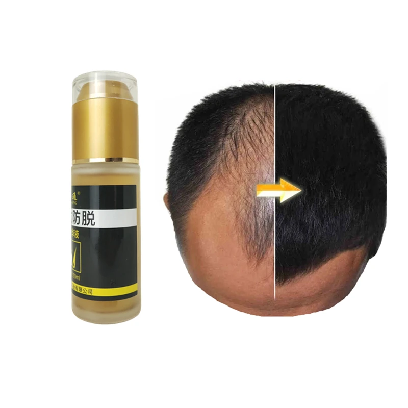 

x minoxidil5 rapid ayurvedic tonic afro hair growth regrowth bald oil growth grow tonic hair treatment grower for men