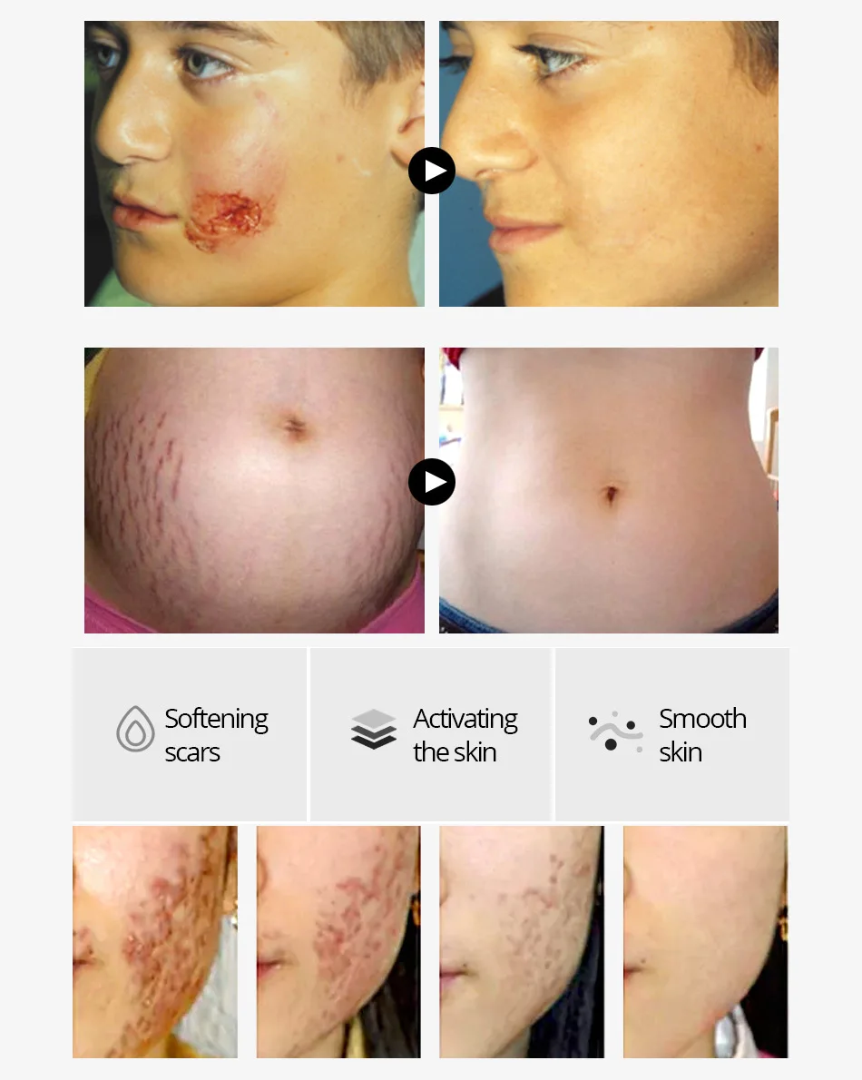Scar serum peptide treatment Vibrant Glamour Crocodile Repair Scar Face Serum Removal Acne Scar