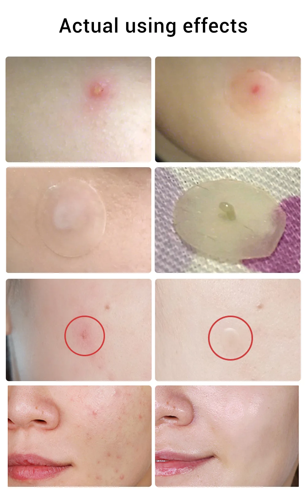 Removal Acne Patch (14).jpg