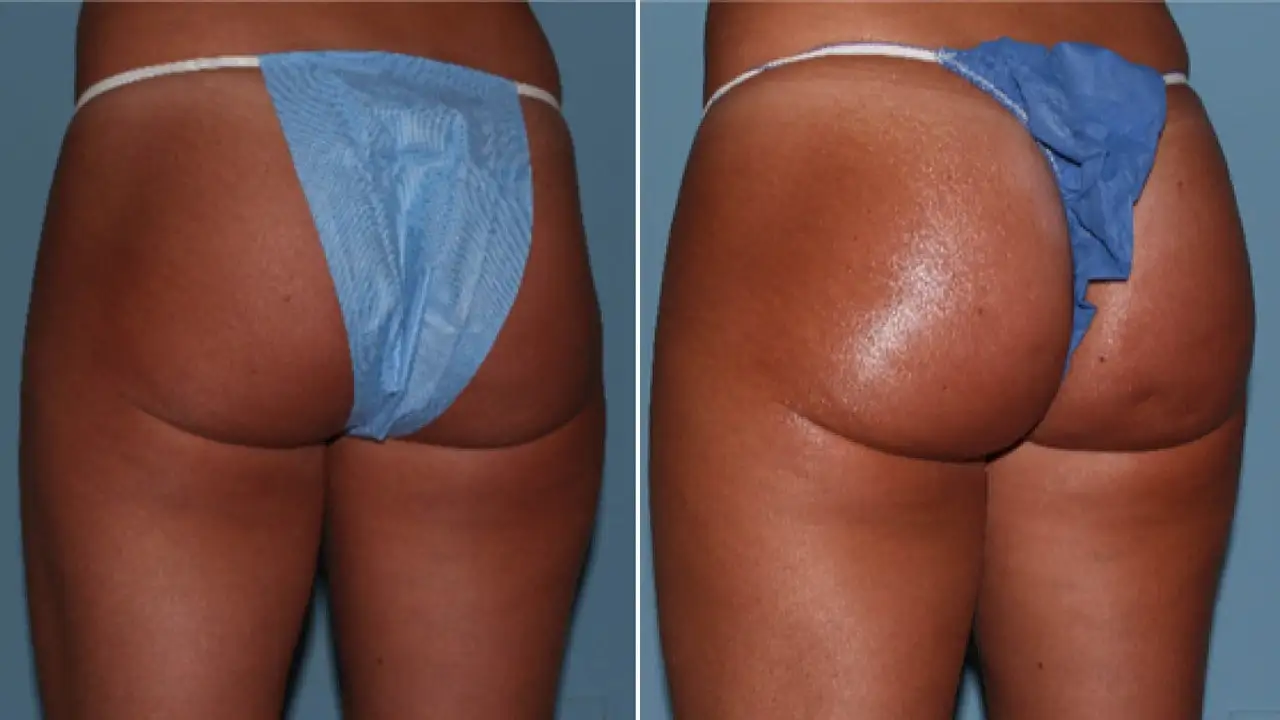 10ml 20ml dermal fillers hyaluronic acid buttock injection to enlarge the buttocks.jpg