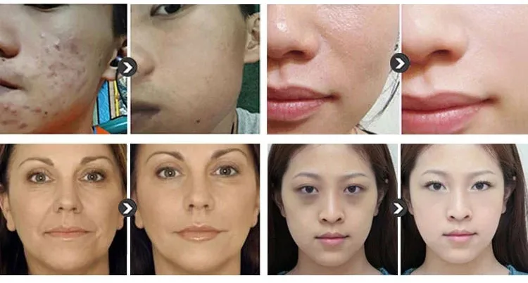 new powfule wireless E30 5 levels speed microneedle system ultima BB glow pen korea derma pen microneedling nano needle dr.pen