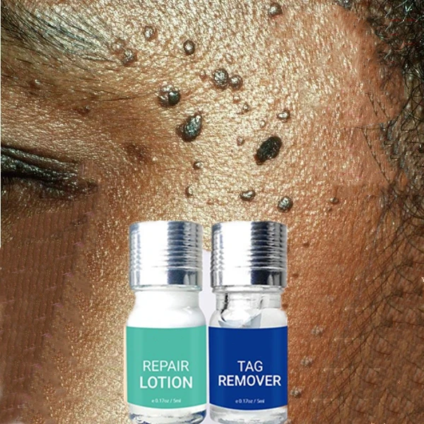 

Warts Remover Ointment Wart Treatment Cream Skin Tag Remover Painless Mole Skin Dark Spot Moles Skin Tags Remover