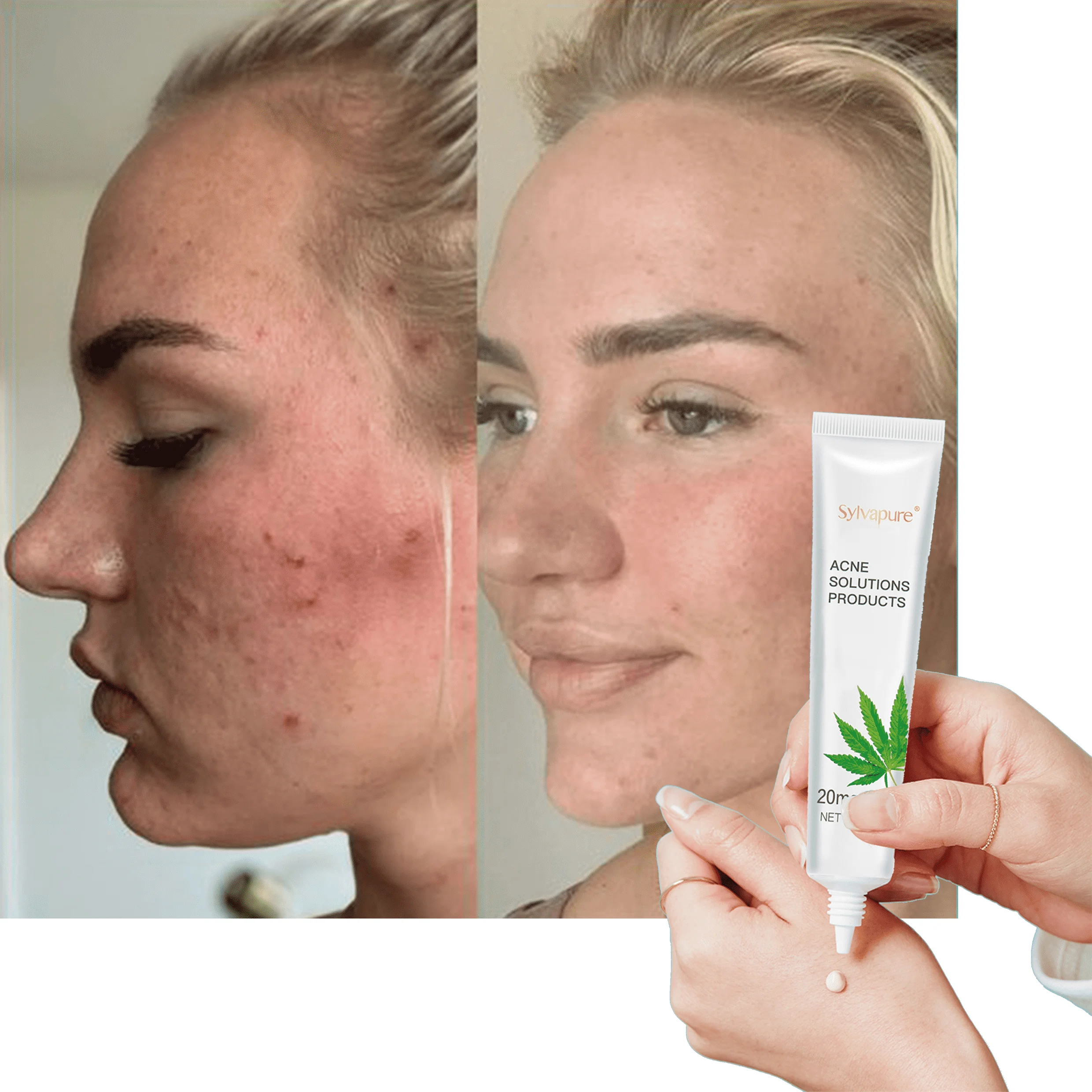 

Acne Scar Stretch Marks Remover Cream Skin Repair Acne treatment no side effects whitening lotion