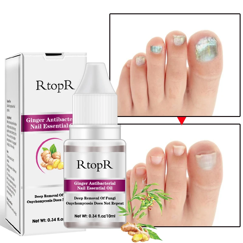 

Ginger Essential Oil Nail Treatment Onychomycosis Paronychia Anti Fungal Nail Infection Toe Nail Fungus Treatment Essence