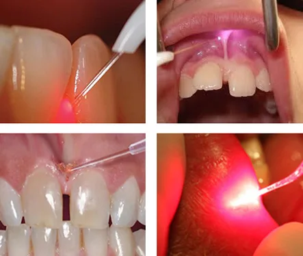 新发明 2020 ce医疗 980nm 1470nm牙科手术激光牙齿美白激光牙龈激光