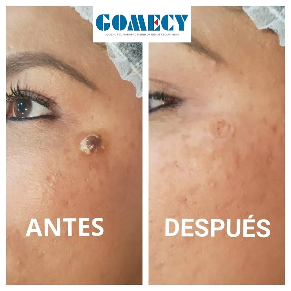 scar removing byCo2 fractional.jpg