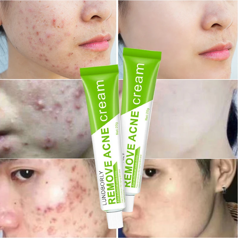 

2021 factory direct sales pretty cowry anti acne Herbal fades acne marks acne cream