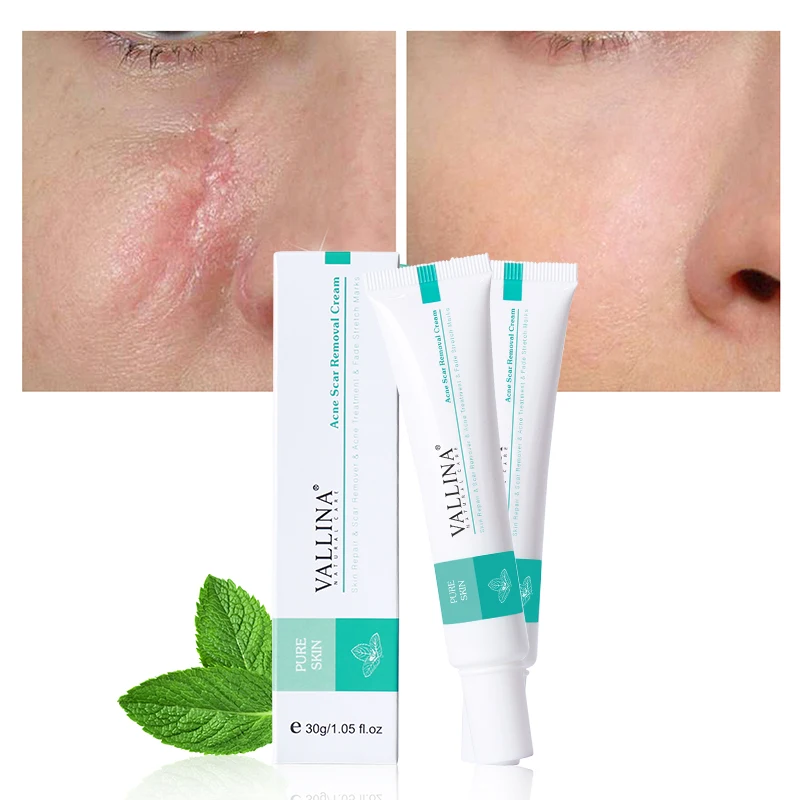 

High Quality Anti Pimples Removing Stretch Marks Acne Scar Removal Cream