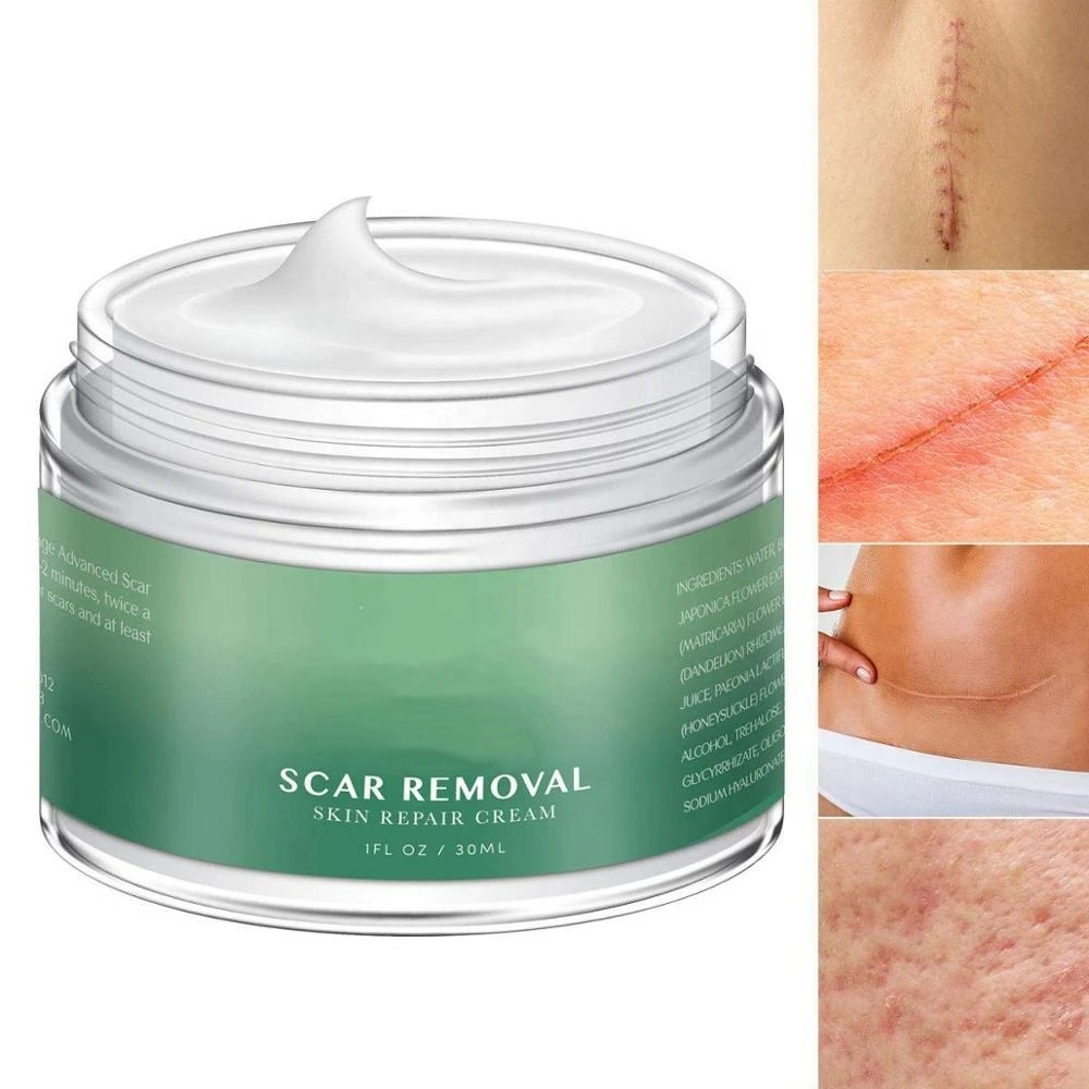 Oem Scar Removal Cream With Natural Herbal Extracts Formula For Old And ...