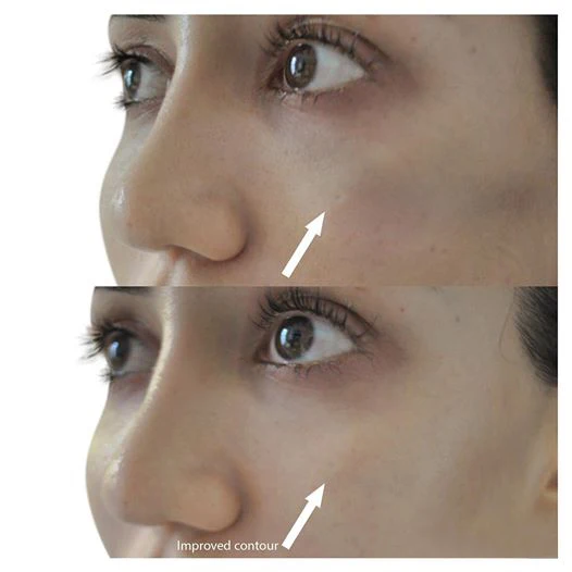 1ml dermal filler hyaluronic acid injection