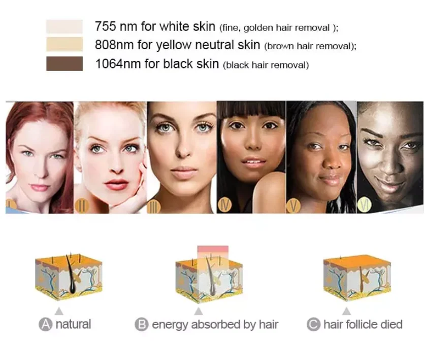 2020 Alma soprano ice laser hair removal machine laser 755 808 1064 triple wavelength diode laser hair removal machine