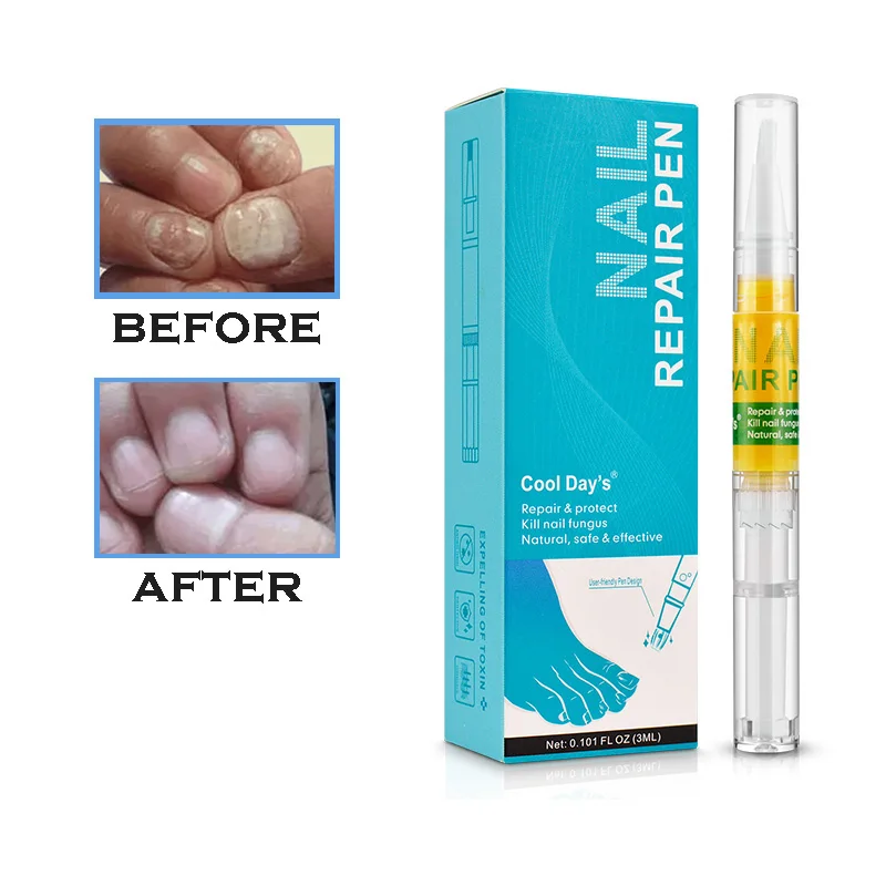 

Anti Fungal Nail Treatment Nail Repair Pen for Onychomycosis Paronychia Finger Toenail Fungus Infection, Transparent