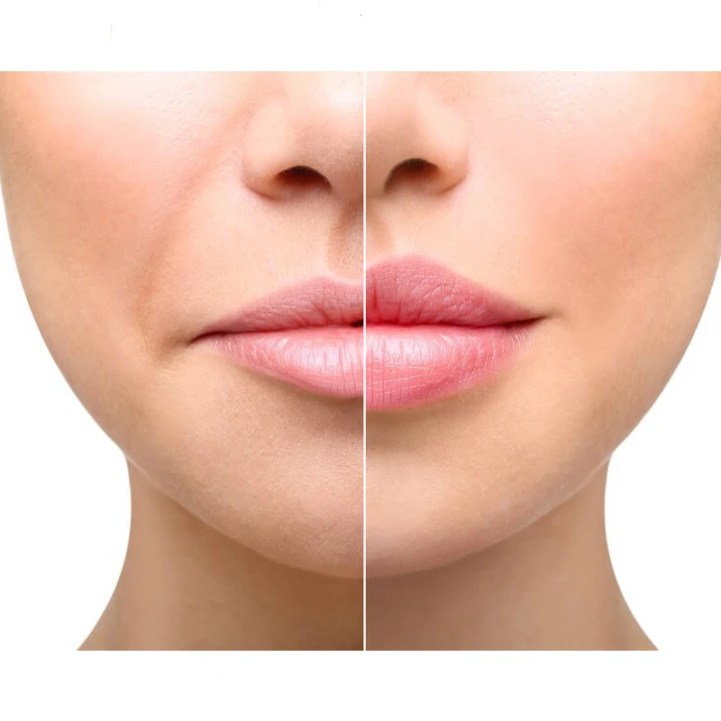 

hyaluronic acid gel lip injections hyaluronic acid filler