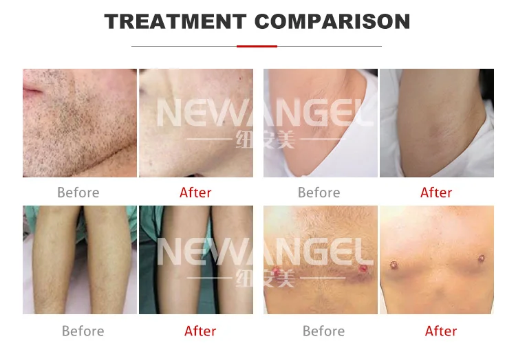 laser hair removal (4).jpg