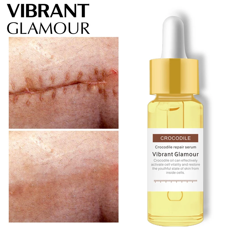 

VIBRANT GLAMOUR Crocodile Repair Scar face serum Removal Acne Scar Whitening for Spots Acne Treatment Stretch Marks Skin Care